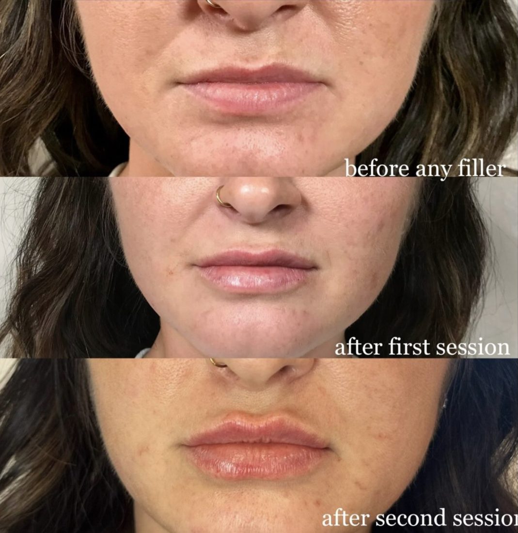 Lip Filler before and after