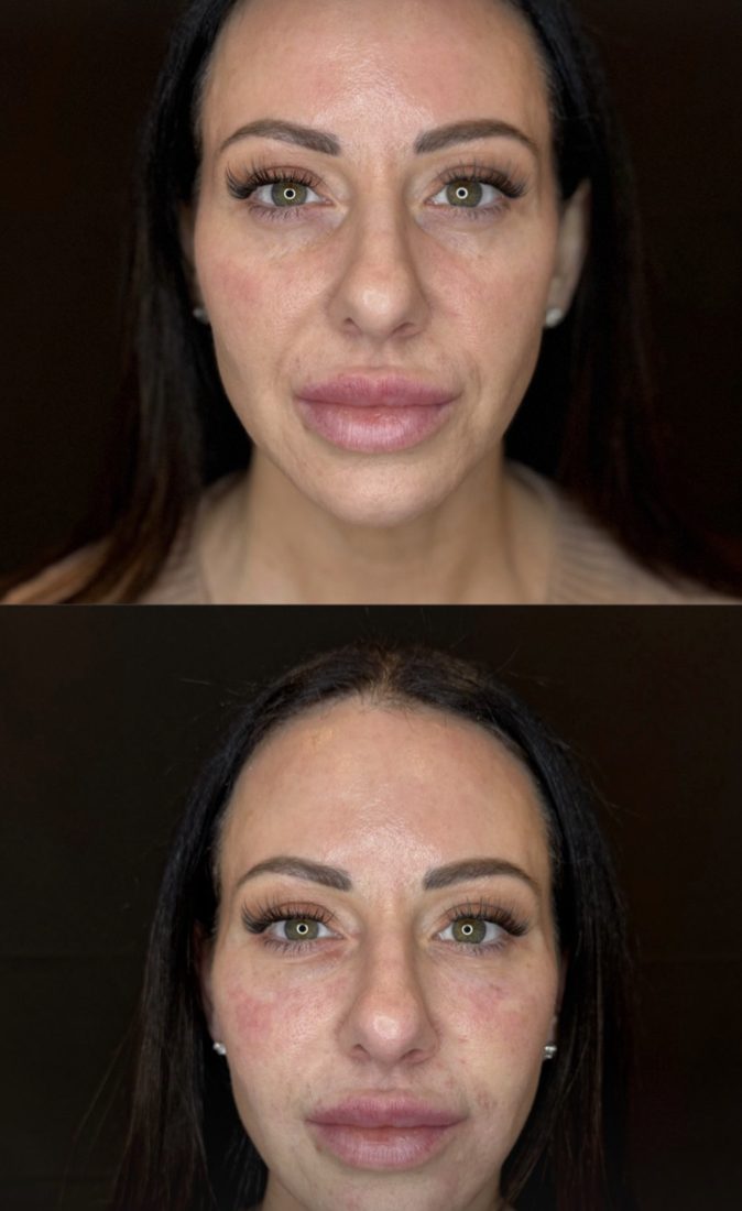 Full-Face Filler before and after