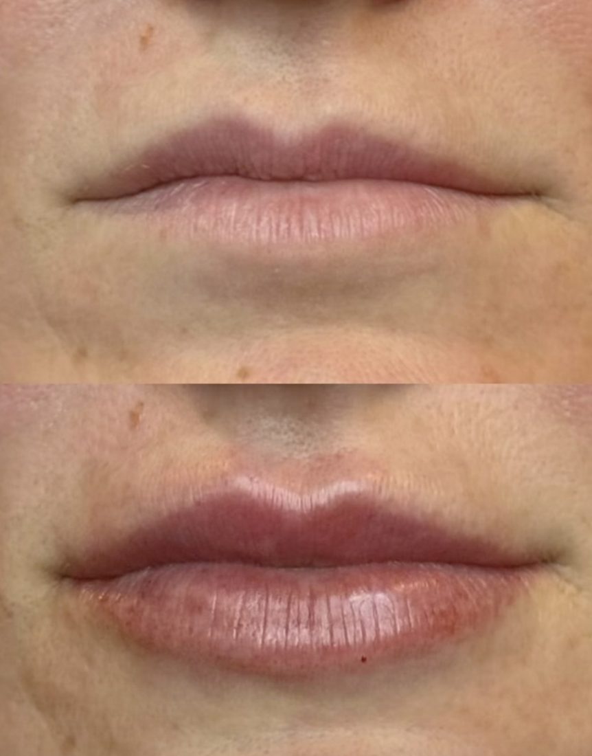 Lip Filler before and after